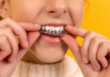 Colocación de un alineador dental transparente