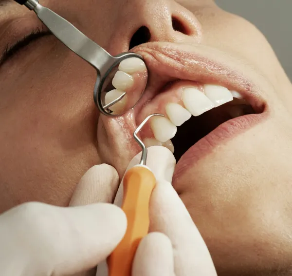 Revisión de los dientes con un espejo dental