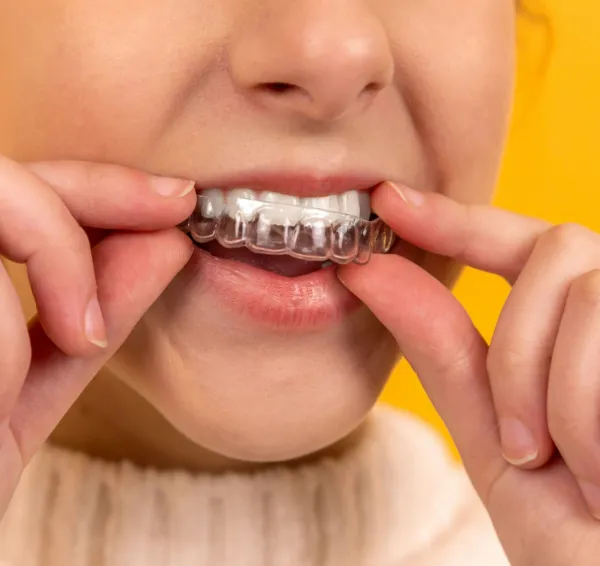Colocación de un alineador dental transparente